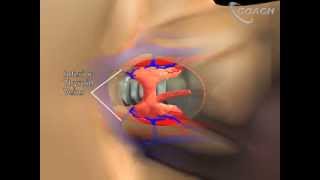 Surgery for Thyroid Disease Minimally Invasive Thyroid Lobectomy [upl. by Murry]