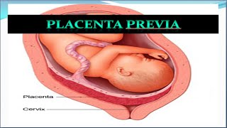 Placenta Previa Update [upl. by Erin]