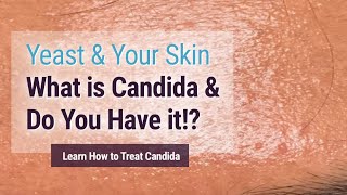 ☑️7 Tips How to get rid of Candida yeast infections Naturally Cure with home remedies🍏 [upl. by Freytag65]