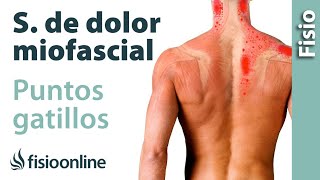 Qué son los puntos gatillo o síndrome de dolor miofascial y su tratamiento [upl. by Frodine]