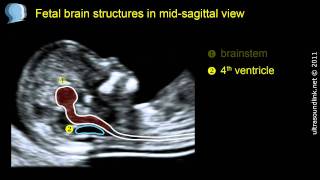 Normal fetal brain anatomy at 1113 weeks  2D scan [upl. by Cristie]