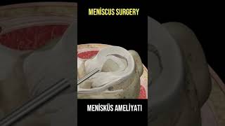 Menisküs Yırtığı Ameliyatı [upl. by Idnis268]