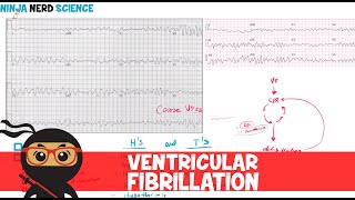 Rate and Rhythm  Ventricular Fibrillation [upl. by Luapnaes872]