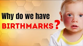 Why do we have Birthmarks  Science Curiosity  Letstute [upl. by Pironi]