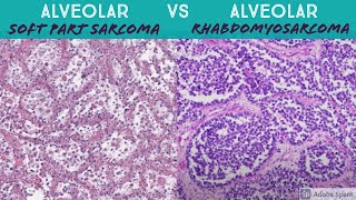 Osteosarcoma GeneralMorphology SubtypesClinical features [upl. by Amalbergas]