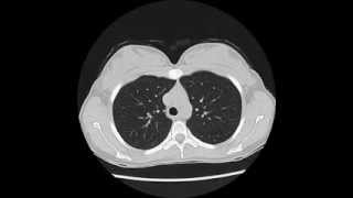 Flexible Bronchoscopy Introduction 6  Airway Inspection Nostril to cords [upl. by Birdie529]