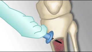 Placement of an Intraosseous Line by MKleinman  OPENPediatrics [upl. by Chucho]