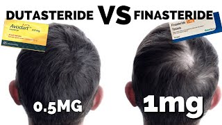 Dutasteride Mega Guide  Better Than Finasteride [upl. by Snashall]