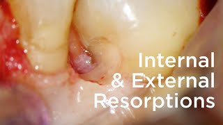 Management of internal and external resorptions  Clinical case [upl. by Tennies309]