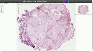 Pleomorphic Adenoma  Histopathology [upl. by Kashden]