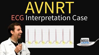 AV Nodal Reentry Tachycardia AVNRT on ECG  EKG [upl. by Aihtiekal]