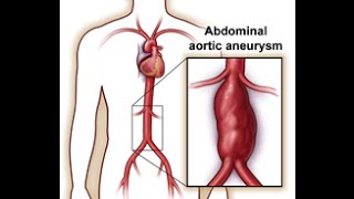 Aorta Versus The IVC [upl. by Drofiar348]