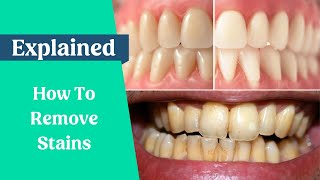 How to remove stains from the teeth [upl. by Ennaesor]