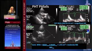 Mitral Stenosis Karla Kurrelmeyer MD [upl. by Aiyotal]