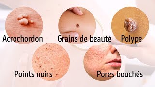 Eczéma  quelles solutions   Allo Docteurs [upl. by Anyrtak]