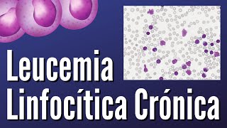 Leucemia Linfocítica Crónica [upl. by Bathulda526]