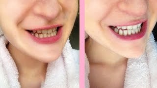 Crest white strips honest review [upl. by Sawtelle]