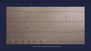 Electrical Alternans ECG [upl. by Joachim]