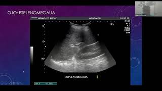 LUNG CANCER  Part 2 Morphology Clinical features [upl. by Grani]