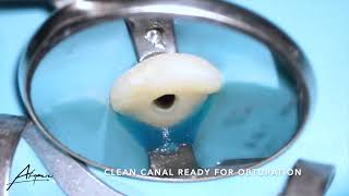 Root canal treatment on the maxillary central incisor tooth 21 [upl. by Birck]