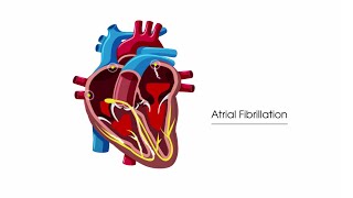 What is atrial fibrillation [upl. by Lerrud]