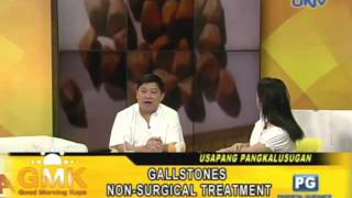 NonSurgical Treatment to Gallstones ENG SUB [upl. by Oicirbaf]