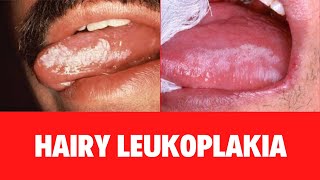 leukoplakia vs lichen planus  10 points to differentiate clinically [upl. by Padriac]