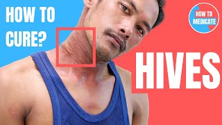 How to treat Hives Urticaria  Doctor Explains [upl. by Ellinehc]