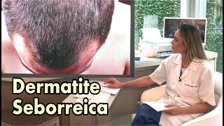 Dermatite Seborreica e Caspa  Conheça as diferenças [upl. by Acinoev119]