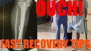 How to Recover Quickly From Broken Leg Fractured Tibia  Fibula ORIF Surgery [upl. by Aniles]