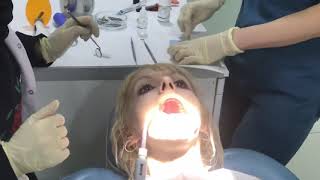 Woman at the dentist watches as her tooth is filled with amalgam [upl. by Hijoung]