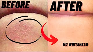 How To Remove Whiteheads And Blackheads From Chin At Home [upl. by Dimo]