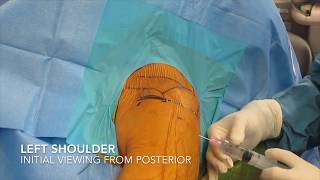 Knee Meniscus Repair  Post Operative Rehabilitation Protocol [upl. by Gyimah]