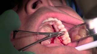 Palatal Gum Grafting [upl. by Forelli]