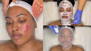 CYSTIC ACNE TREATMENT  WALKIN FACIAL FOR GRADE 3 AND 4 ACNE WITH PRO TIPS  LICENSED ESTHETICIAN [upl. by Llerat545]