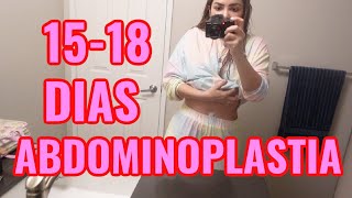 ABDOMINOPLASTIA 15  18 DIAS DESPUES [upl. by Addie167]