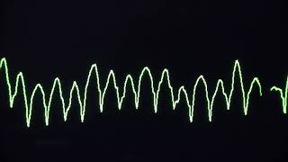 Atrial fibrillation Ablation for Patients [upl. by Adrahs834]