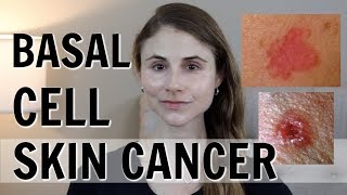 BASAL CELL SKIN CANCER WHAT YOU SHOULD KNOW DR DRAY [upl. by Amalle795]