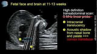 Fetal face and brain high definition scan at 1113 weeks [upl. by Torras167]