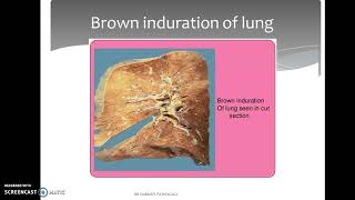 Hyperemia and Congestion [upl. by January]