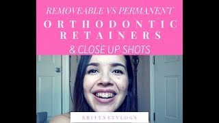 PROS amp CONS CLOSE UPs ORTHODONTIC RETAINERS BRACES UPDATE [upl. by Ready]