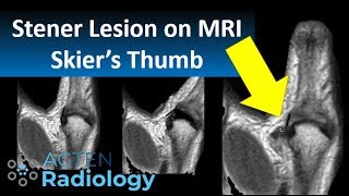 Stener Lesion Skiers Thumb on MRI [upl. by Croix432]