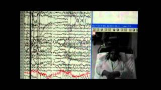 Nonepileptic seizures with levetiracetam therapy  Supplementary video 60089 [upl. by Gretchen303]