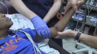 Posterior Elbow Dislocation Reduction [upl. by Atteval]