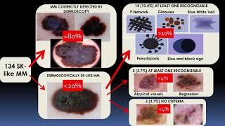 Seborrheic Keratosislike melanomas  Dr Cristina Carrera [upl. by Jodoin140]