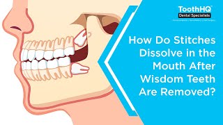 How do stitches dissolve in the mouth after wisdom teeth are removed [upl. by Nahgem]