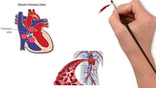 Pulmonary valve stenosis [upl. by Oap899]