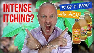 Poison Ivy Remedy STOP Itching FAST  Dr Doug Willen [upl. by Tallula]