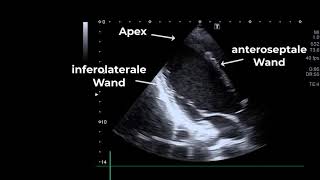 Anleitung Echokardiografie – subkostale Darstellung mit Ultraschall [upl. by Eellah]