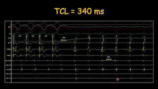 How to assess entrainment response in AVNRT [upl. by Atikehs426]